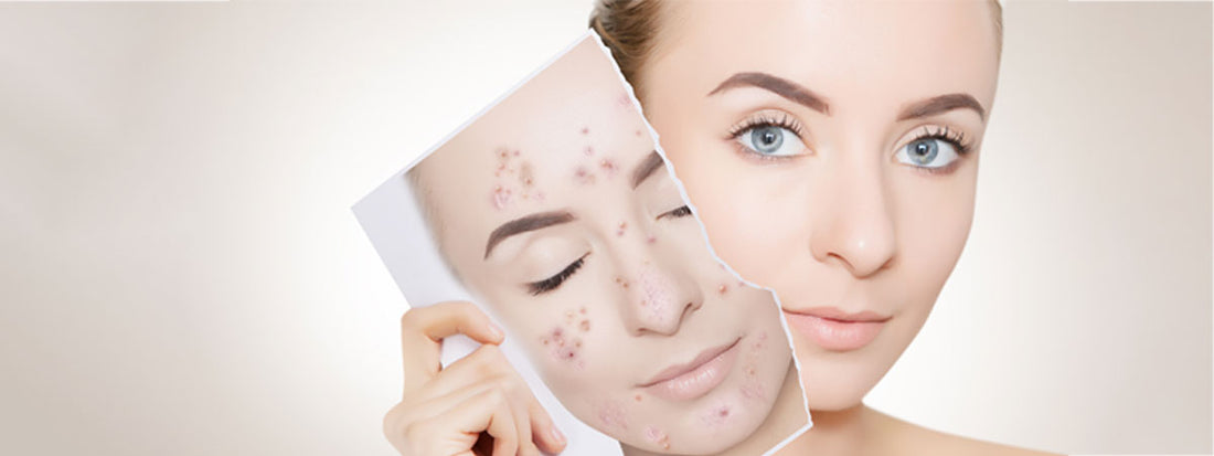 A woman holding a picture of herself with acne.